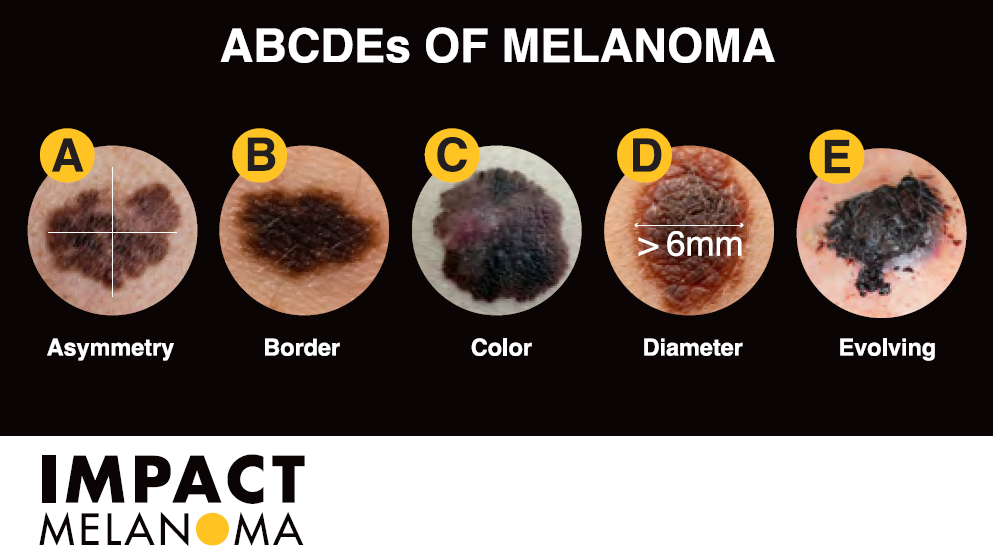 A chart of ABCDE's of Melanoma
